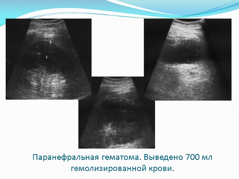 Паранефральная гематома. Выведено 700 мл гемолизированной крови.